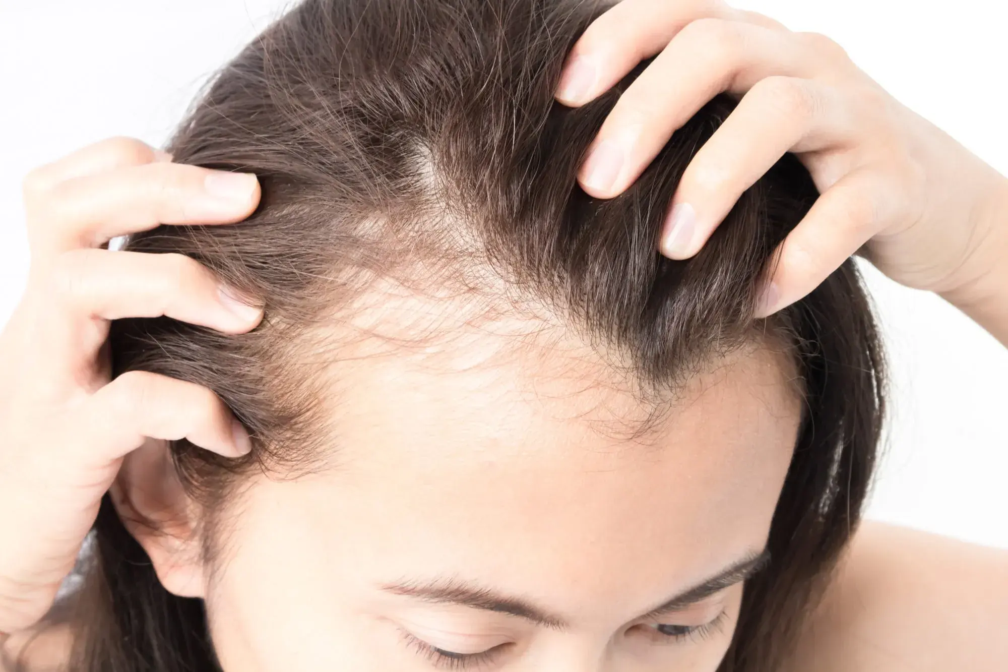 5 Major Causes of Hair Loss