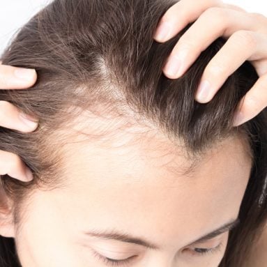 5 Major Causes of Hair Loss